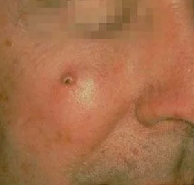 SQUAMOUS CELL CARCINOMA