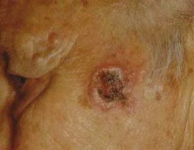 SQUAMOUS CELL CARCINOMA