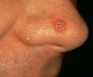 SQUAMOUS CELL CARCINOMA