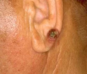 SQUAMOUS CELL CARCINOMA