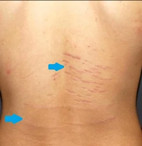 STRIAE DISTENSAE