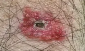 SUPERFICIAL SPREADING AMELANOTIC MELANOMA