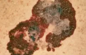 SUPERFICIAL SPREADING MELANOMA