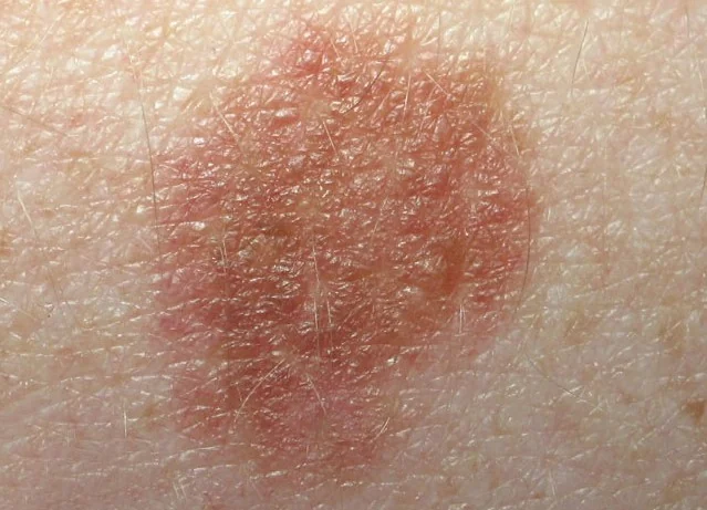 SOLID PINK NEVUS