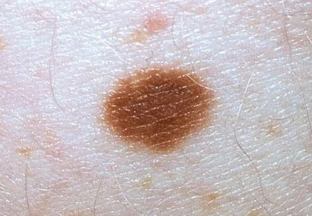 SOLID NEVUS