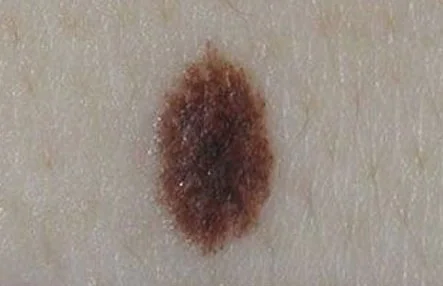 JUNCTIONAL NEVUS