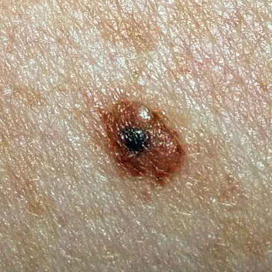 COMBINED NEVUS