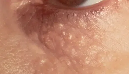 SYRINGOMA