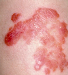 CUTANEOUS TUBERCULOSIS