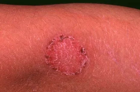 TINEA CORPORIS