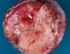 TRICHILEMMAL CYST