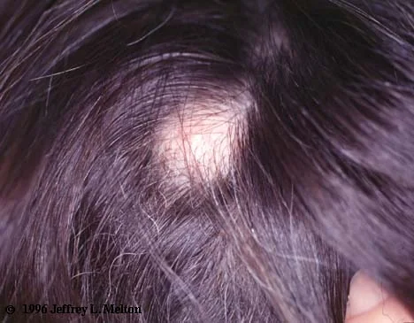 TRICHILEMMAL CYST