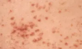 URTICARIA PIGMENTOSA