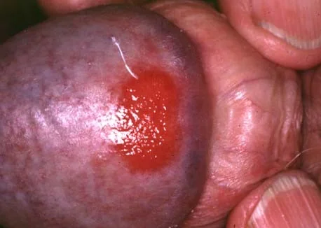 ZOON'S BALANITIS