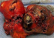 INFLAMMED THYROGLOSSAL DUCT CYST. (Courtesy Dr . V . Penopoulos).
