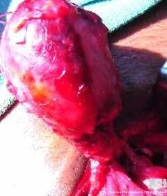 BRANCHIAL CLEFT CYST . (Courtesy Dr . V . Penopoulos).