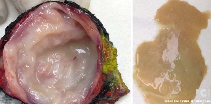 CROSS SECTION BRANCHIAL CLEFT CYST . (Courtesy Dr . V . Penopoulos).