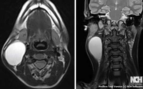 SIZEABLE BRANCHIAL CYST .(Courtesy Dr . V . Penopoulos).