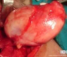 PARAPHARYNGEAL BRANCHIAL CLEFT CYST. (Courtesy Dr . V . Penopoulos).