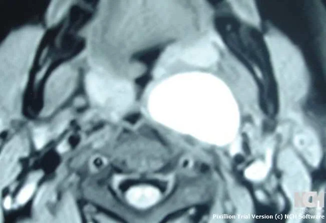 PARAPHARYNGEAL BRANCHIAL CLEFT CYST . (Courtesy Dr . V . Penopoulos).