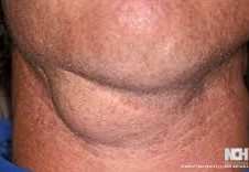 BRANCHIAL CLEFT CYST . (Courtesy Dr . V . Penopoulos).