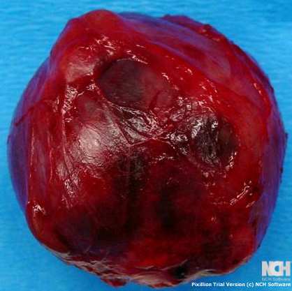 BRANCHIAL CLEFT CYST . (Courtesy Dr . V . Penopoulos).