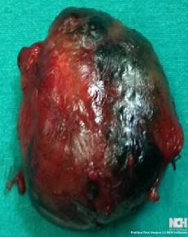 BRANCHIAL CLEFT CYST . (Courtesy Dr . V . Penopoulos).