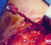 EXCISION OF BRANCHIAL CLEFT SINUS . (Courtesy Dr . V . Penopoulos).