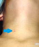 BRANCHIAL CLEFT SINUS . (Courtesy Dr . V . Penopoulos).