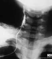 Syringography . BRANCHIAL CLEFT SINUS. (Courtesy Dr . V . Penopoulos).