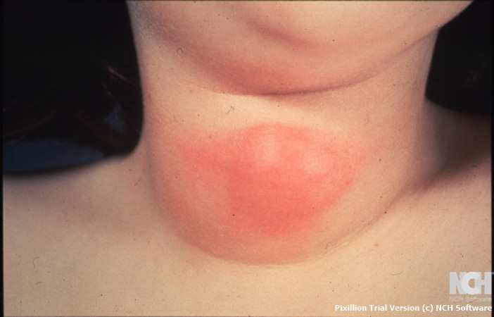 INFLAMMED THYROGLOSSAL DUCT CYST. (Courtesy Dr . V . Penopoulos).