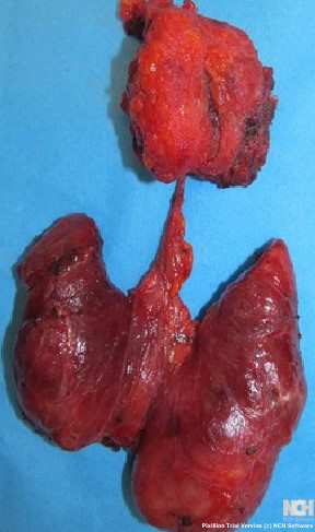 THYROGLOSSAL DUCT REMNANT CYST . (Courtesy Dr . V . Penopoulos).