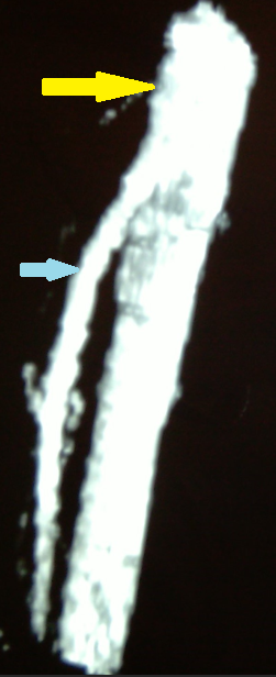 SUPERIOR MESENTERIC ARTERY SYNDROME . (Courtesy Dr . V . Penopoulos).
