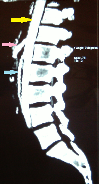 SUPERIOR MESENTERIC ARTERY SYNDROME . (Courtesy Dr . V . Penopoulos).