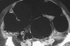 OGILVIE'S SYNDROME . (Courtesy Dr . V . Penopoulos).