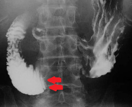 SUPERIOR MESENTERIC ARTERY SYNDROME . (Courtesy Dr . V . Penopoulos).
