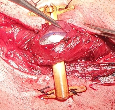 Boerhaave Syndrome . Esophagostomy . (Courtesy Dr.V.Penopoulos).