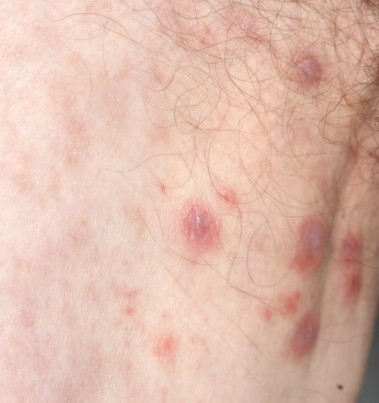 BAZEX SYNDROME . (Courtesy Dr . V . Penopoulos).