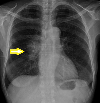 BAZEX SYNDROME .(Courtesy Dr . V . Penopoulos).