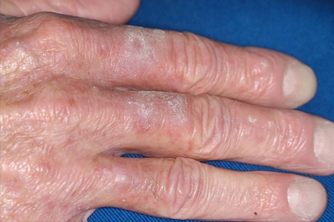 BAZEX SYNDROME .  (Courtesy Dr . V . Penopoulos).
