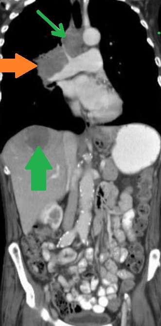 BAZEX SYNDROME . (Courtesy Dr . V . Penopoulos).