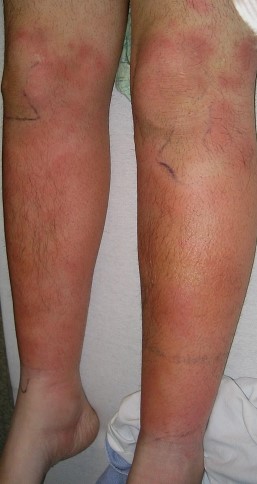 SWEET SYNDROME - ERYTHEMA NODOSUM . (Courtesy Dr . V . Penopoulos).