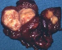BILATERAL MEDULLARY CARCINOMA - MEN 2