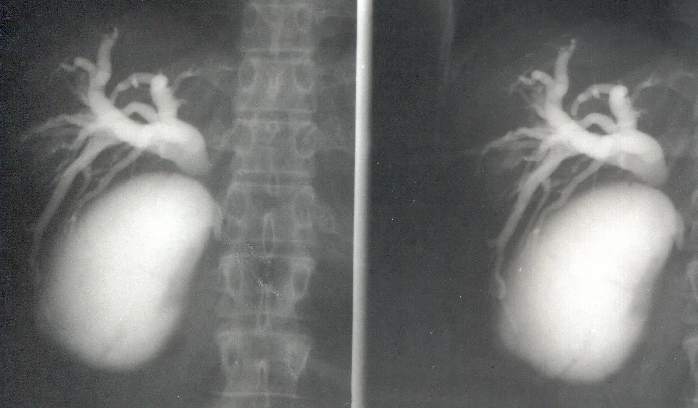 MIRIZZI SYNDROME . (Courtesy Dr . V . Penopoulos).