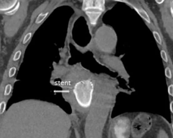 BOERHAAVE SYNDROME - STENT PLACEMENT