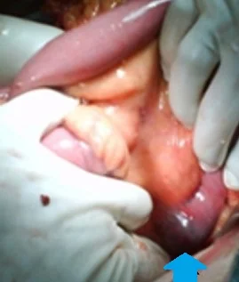 BOUVERET'S  SYNDROME