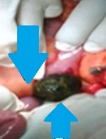 BOUVERET'S SYNDROME