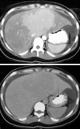 BUDD - CHIARI SYNDROME . (Courtesy Dr . V . Penopoulos).