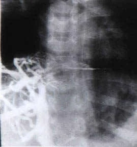 BUDD - CHIARI SYNDROME . (Courtesy Dr . V . Penopoulos).