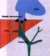 BUDD - CHIARI SYNDROME - SCHEMATIC ILLUSTRATION